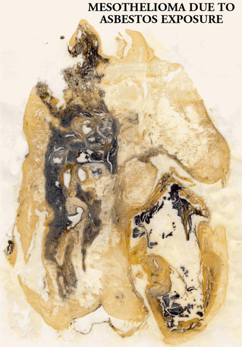 Mesothelioma_due_to_asbestos_expo_2